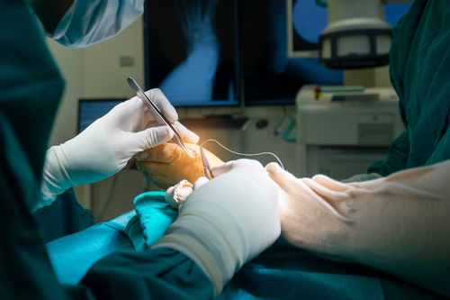 Podiatrist performing bunion surgery on a patient's foot in operating room